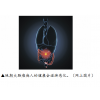 肠癌新标靶,疗效高  两类人士尽早筛查防止恶化
